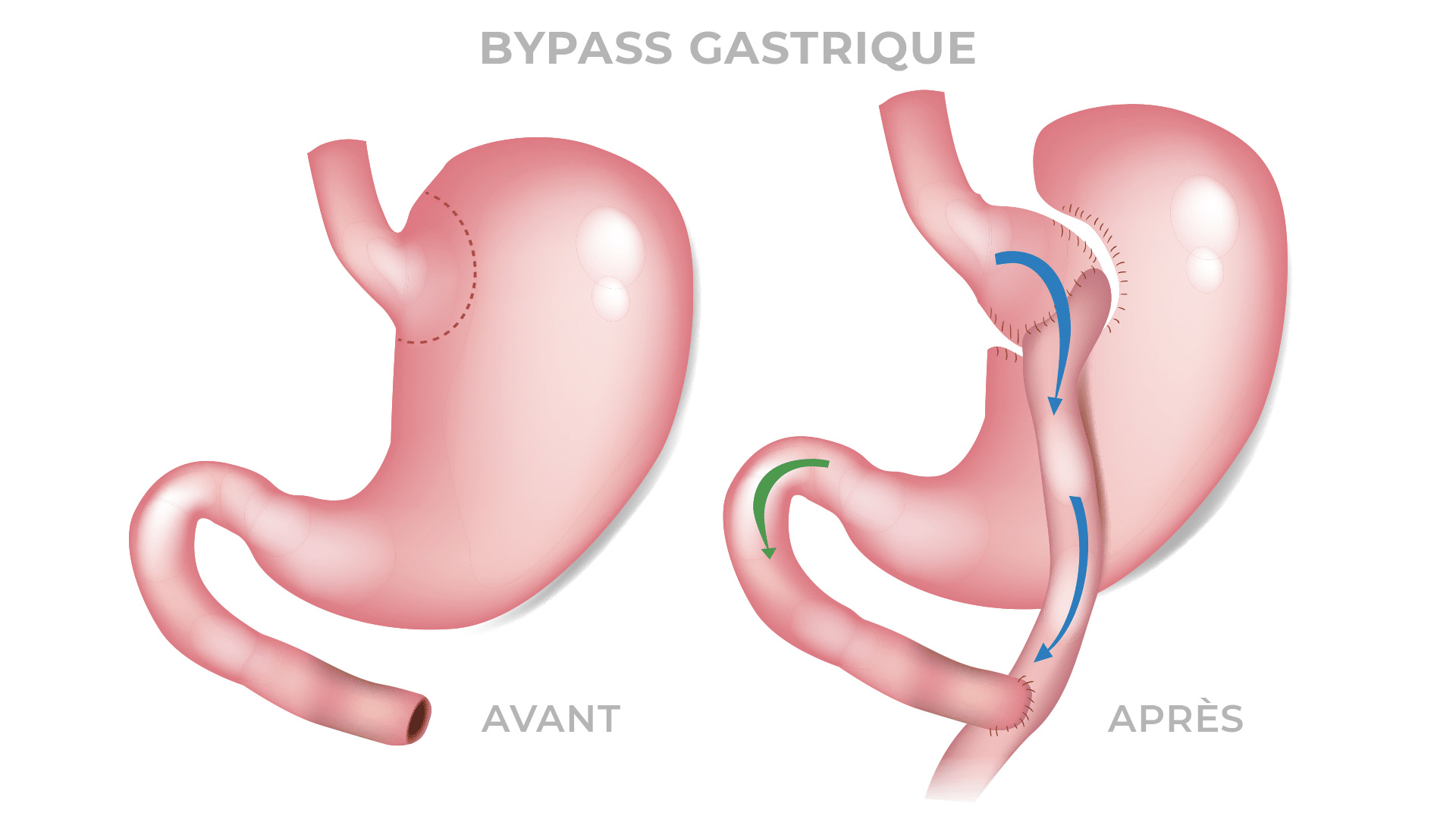 La Dilatation De L Estomac Apres Un Bypass Gastrique Dr Servajean Paris